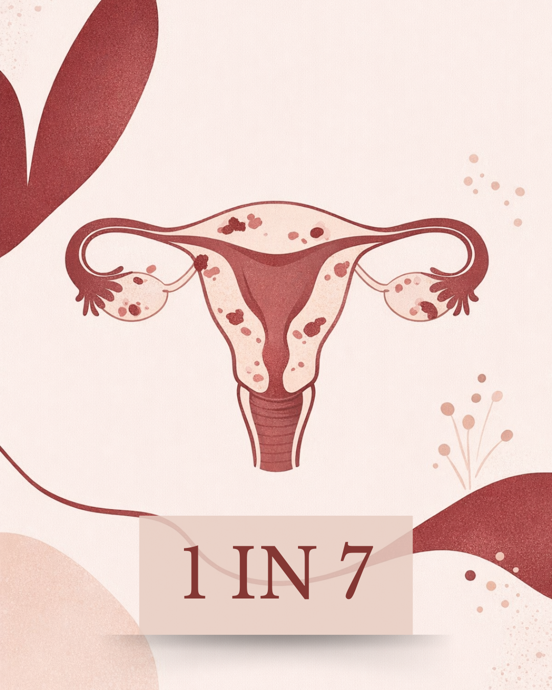 Endometriosis: What Every Woman Should Know